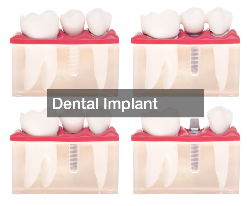 dental implants